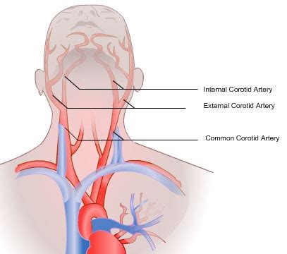 Headaches and dizziness online course: Gaurdian-Arteries | Vascular Concept