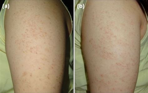 10 natural keratosis pilaris remedies to treat the annoying arm bumps or 'chicken skin.' although there is no known cure for kp, there are plenty of natural ways to treat your skin at home. What Does Keratosis Pilaris Look Like? | FindATopDoc