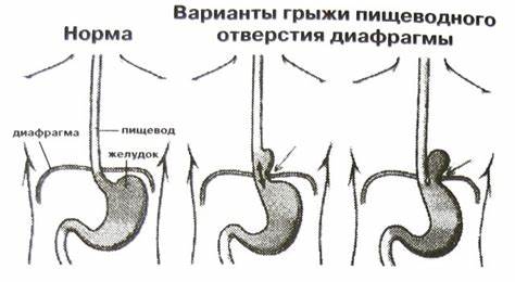 Грибок пищевода лечение диета Хиатальная грыжа глазами и руками остеопата - Остеопатия - путь к здоровью Хиатальная грыжа глазами и руками остеопата - Остеопатия - путь к здоровью Грибок пищевода лечение диета