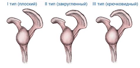 Bigliani, l.u., morrison, d.s., april, e.w. Почему болят плечевые суставы: причины и лечение травм плеча