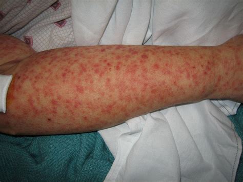 The marburg virus is a hemorrhagic fever virus. Высыпания при менингите: как выглядят и в чем причина ...