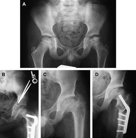 The osteochondroses typically are characterized by degeneration and subsequent regeneration of the. Principles of Treating the Sequelae of Perthes Disease ...