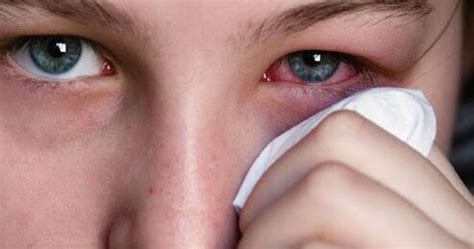 Can herpes simplex cause an eye infection? Encyclopedia of Medicine: Herpes simplex eye infection