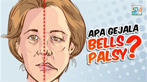 Saraf wajah adalah saraf kranial ketujuh, dan saraf ini memasok otot untuk ekspresi wajah. Apa Penyebab Penyakit Bells Palsy - Berbagai Sebab