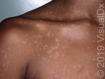 Ringworm is referred to by other names depending on the part of the body that is affected. Common Complaints - Fungal Skin Infections | skinsight