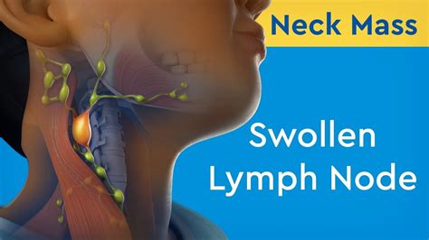 We did not find results for: Neck Mass: Swollen Lymph Node - Practical Motivation