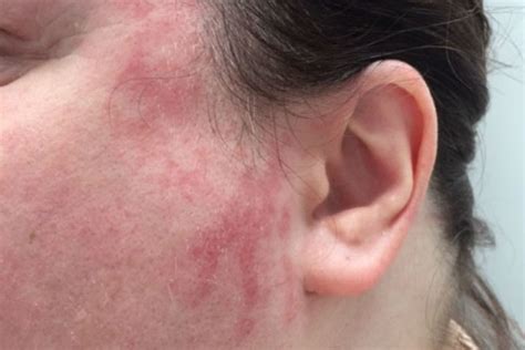 The rash can occur on face or on legs. SunLive - Problematic water causes skin rash - The Bay's ...