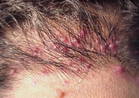 These tiny bumps may appear at the back, top and sides of the head. Ingrown Hair on Scalp: Pictures, Causes, Symptoms ...