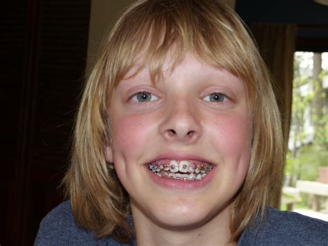 In fact, it can be painful to eat with braces, especially for the first. Deep Cover Day: Braces!