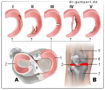 Meniskusriss übungen helfen dir direkt nach der verletzung oder nach einer meniskusriss op. Abbildung Meniskusriss