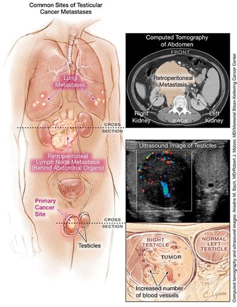 Various imaging procedures may be performed to help determine whether the testicular cancer has spread to other parts of the body or. Testicular Cancer | Oncology | JAMA | JAMA Network