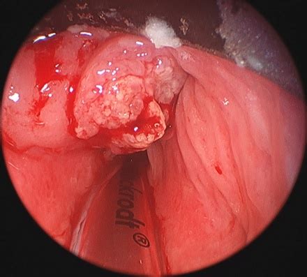 Thyroid cancer is a rare cancer with 4 different types. Symptoms and Pictures of Throat Cancer | MedGuidance