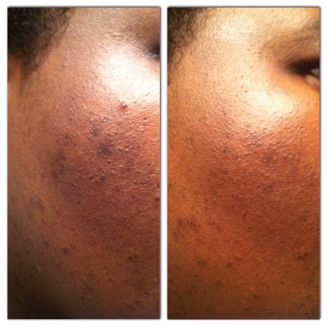 Very often commercial types of black soap contain added. The Magic of Black Soap- Before and After (after 30 days ...