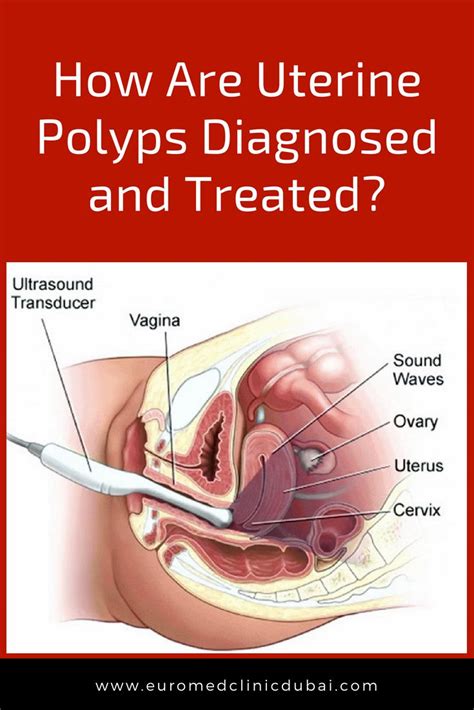 It is important to identify polyps at an early do i need to remove polyps in the uterus? Pin by Healthylicious on Women's health | Uterine polyps ...