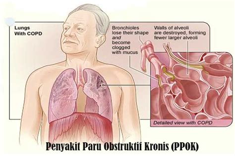 Bronkitis akut dan bronkitis kronis. Penyakit Paru Obstruktif Kronis (PPOK), Penyebab Serta ...