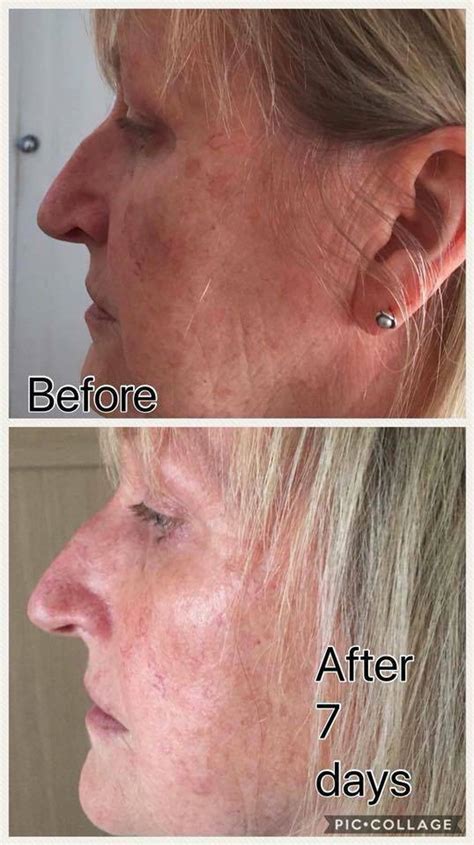 Pesan trulum synergy skincare via agen trulum synergy skincare malaysia line trulum synergy skincare khusus buat anda yang mau mendapatkan hasil kecantikan secara alami. Trulum Review : Trulum Skincare Review Archives - Review trulum vs pratista untuk bopeng bekas ...