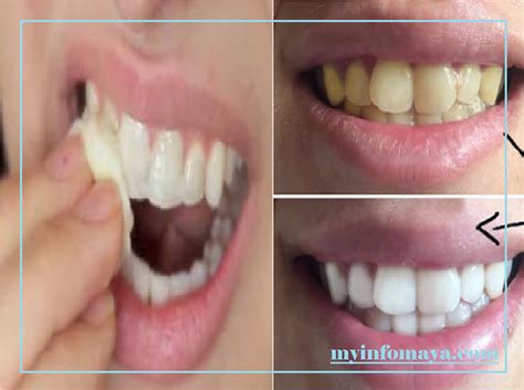 Pastikan semua permukaan gigi terlapisi oleh baking soda. Gigi Kuning Tak Cantik , Ini Cara Memutihkan Gigi Pakai ...