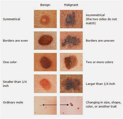 Skin cancer is one of the most common forms of cancer and can appear anywhere on the skin. Signs of Skin Cancer in Children
