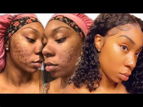 To maintain a skin care regime that works best for your particular type is a must, to keep all the skin issues and troubles at bay. BEST WAY TO FADE ACNE SCARS AND HYPERPIGMENTATION FOR GOOD ...