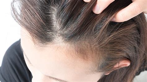 Punca rambut gugur cara mengatasi atau merawat rambut gugur via nutrisiguru.wordpress.com. Ubat Untuk Rambut Gugur Dan Beruban - Catet i