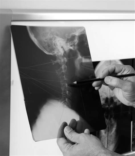 Georgia On-the-Job Injury Lawyers for Bone Fracture Claims
