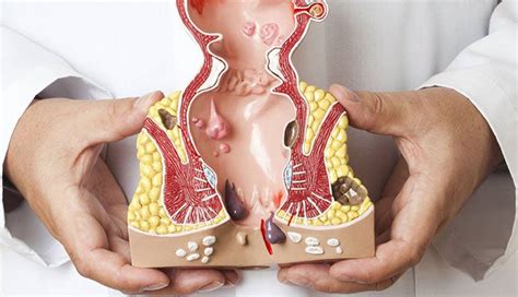 Every year in the u.s., approximately 57,000 people die from colorectal. Signs of Ulcerative Colitis | New Life Ticket