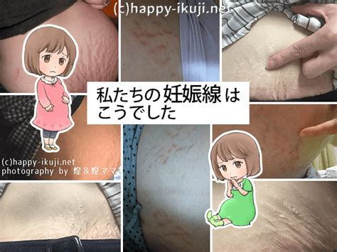 お腹がかゆい妊婦さんは注意して!妊娠中期・妊娠後期のかゆみ ...