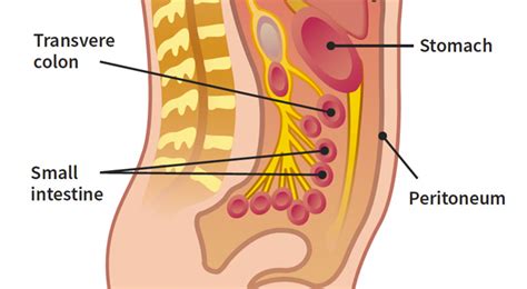 Check spelling or type a new query. Primary Peritoneal Cancer: Know the Basics