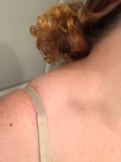 Looking at the skin over the lump there is no. Swelling/Lump on right above collarbone (arms, physician ...