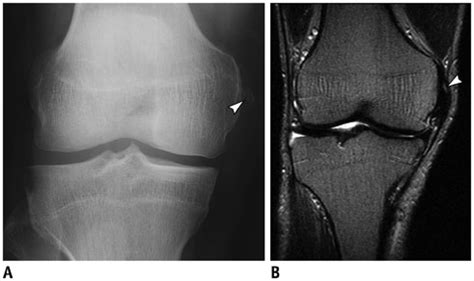 Is the presence of a radiological finding of calcification on the medial side of the knee as a consequence. xmlinkhub