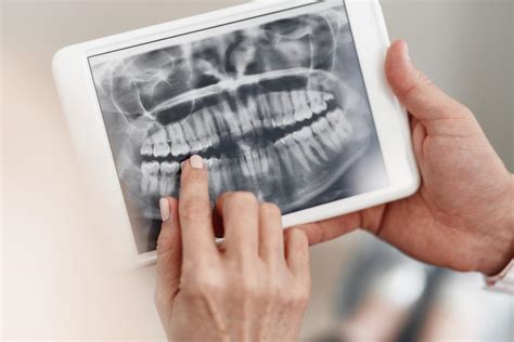 The experienced dentists at bonita del rey dental care provide teeth tomorrow, dental implants, cerec crowns, and more. Dry socket: Symptoms, risk factors, and treatment - Dental ...