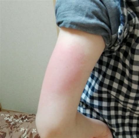 通院日（day357)＆インフルの予防接種後の腫れ「こんなに痒い ...