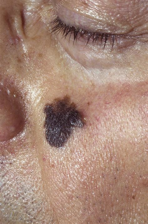 This is a skin condition, also known as hutchinson's lentigo maligna is commonly encountered in people who have entered their 9th decade, the most affected areas being. Lentigo maligna melanoma skin cancer - Stock Image - C040 ...