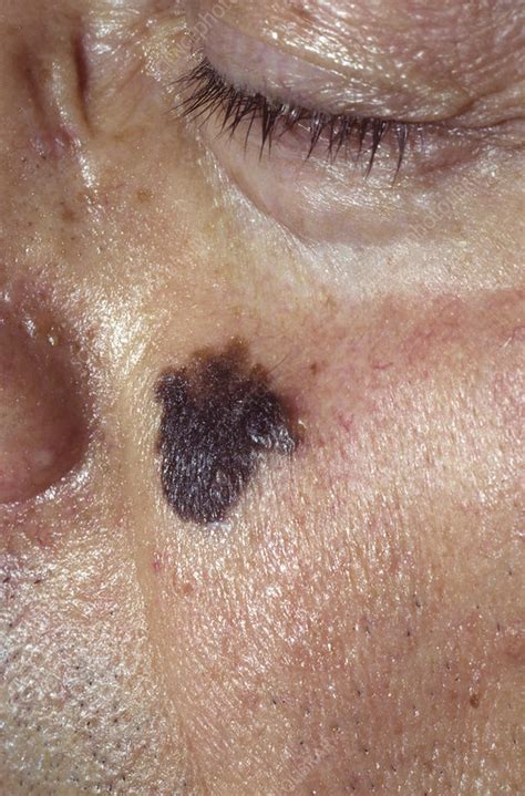 The test is easy and takes only a few minutes. Lentigo maligna melanoma skin cancer - Stock Image - C040 ...