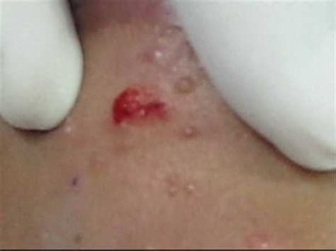 But before we explain how to get rid of molluscum warts, you might be curious as to what these topical acids such as cantharidin which is the extraction from beetles (also called beetlejuice). Treatment of Molluscum Contagiosum.wmv - YouTube