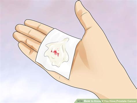 Lymphoma is a type of cancer that can affect the eye. 4 Ways to Know if You Have Prostate Cancer - wikiHow