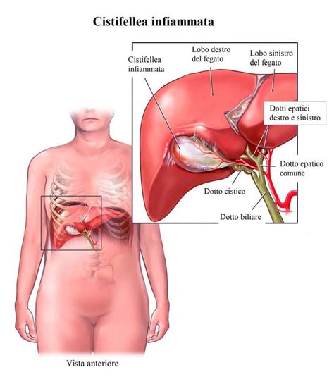 I sintomi, le cure e i consigli utili su dieta e alimentazione. Dolore alla scapola sinistra o destra