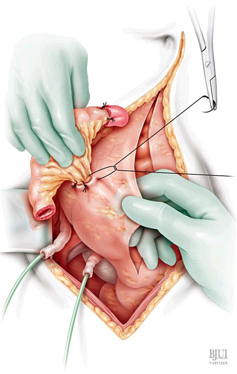 Extraperitoneal ileal conduit - Gillitzer - 2011 - BJU ...