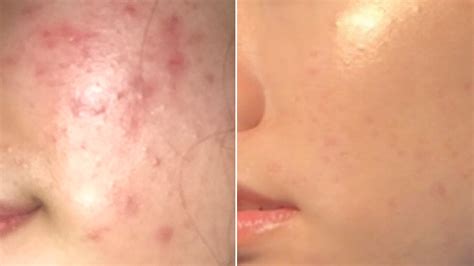 If your goal is to treat acne and banish it forever, you are going to need a skin care routine. Woman's Skin-Care Routine for Acne Goes Viral - Before and ...