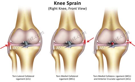 There is mild damage to the treatment will depend on the severity of the sprain and whether there is damage to other parts of the. Knee Sprain|Classifications|Causes|Symptoms|Risk Factors