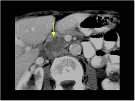Abdomen and retroperitoneum | 1.3 Pancreas : Case 1.3.1 ...