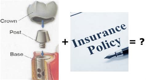 Dental implant numerous dental insurance coverage plans will cover bridges, and many of them now cover implants as well. Dental Implant Insurance: 12 Options That Save You Money...