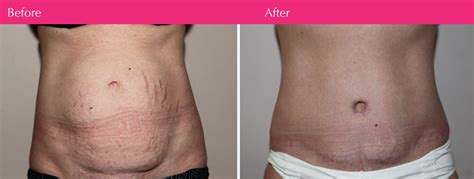 View all male tummy tuck before and after photos from ennis plastic surgery. 80 Real Patient Tummy Tuck Before and After Photos ...