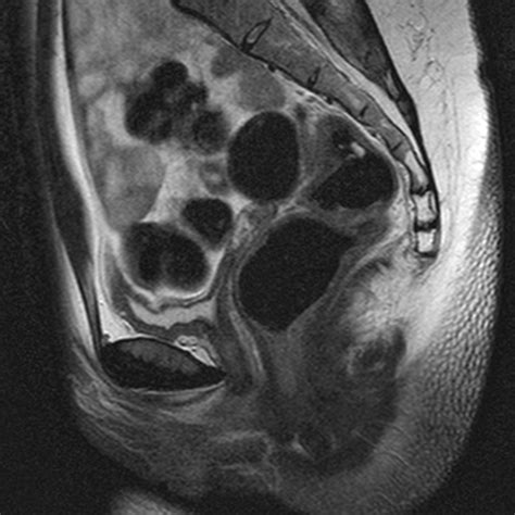 Management of patients with müllerian agenesis. Opinions on Müllerian agenesis