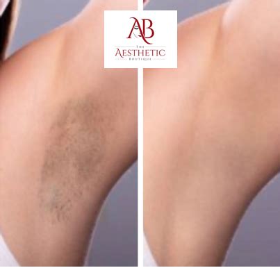 Kevin duplechain is your partner in aesthetics. Laser Services | Lafayette, La | The Aesthetic Boutique