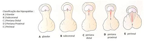 Hipospadias çocukluk yaşta onarılması gereken doğumsal bir anomalidir. Cirurgia Pediátrica Curitiba | Dra. Karimy H. Mehanna ...