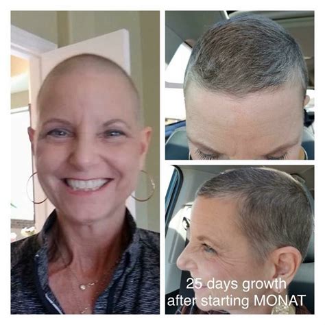 Not everyone undergoing chemotherapy will experience hair loss. Linda finished chemo in October. Her hair was not growing ...