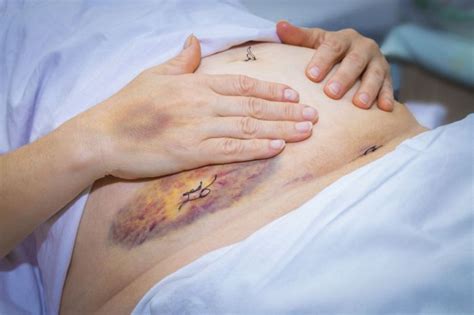 Endometriozda bachadon shilliq qavati ham xuddi shu singari mushak qavat hujayralariga, tuxumdon, bachadon naylari, ba'zan esa siydik pufagi va ichakka o'sib kiradi. Endometrioza objawy | Endometrioza leczenie