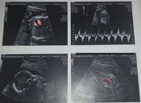 Su bebé semana a semana. ¿Qué se mira en la ecografía de las 20 semanas? | Mamuchi.es