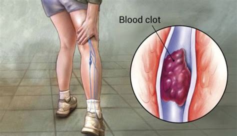 Knowledge of pancreatic cancer is key. 10 Common Signs of Pancreatic Cancer | New Life Ticket ...
